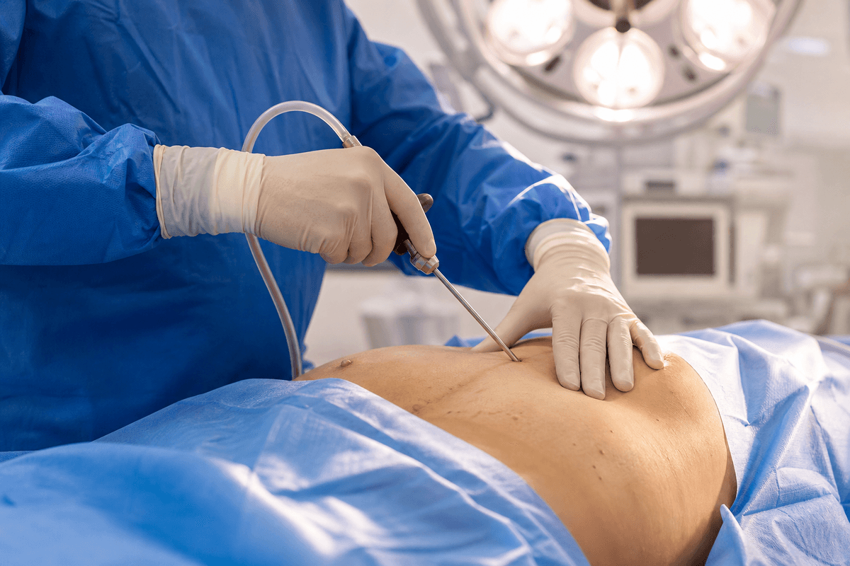 Gynecomastia Surgery
